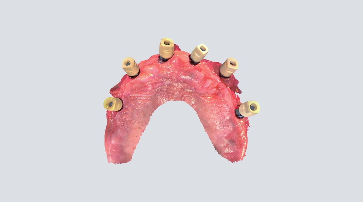 Aoralscan 3: flujo digital para implantología