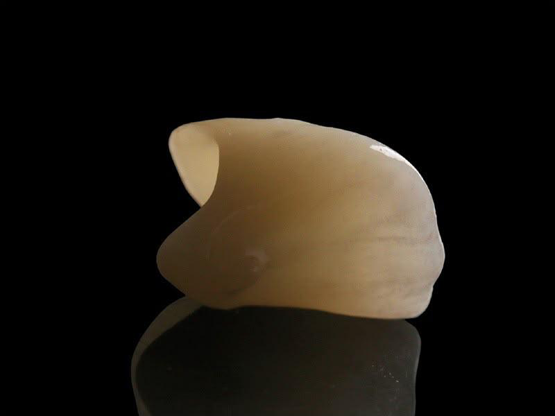 ZINTER Lumina - restauración dental lateral, resultado de referencia