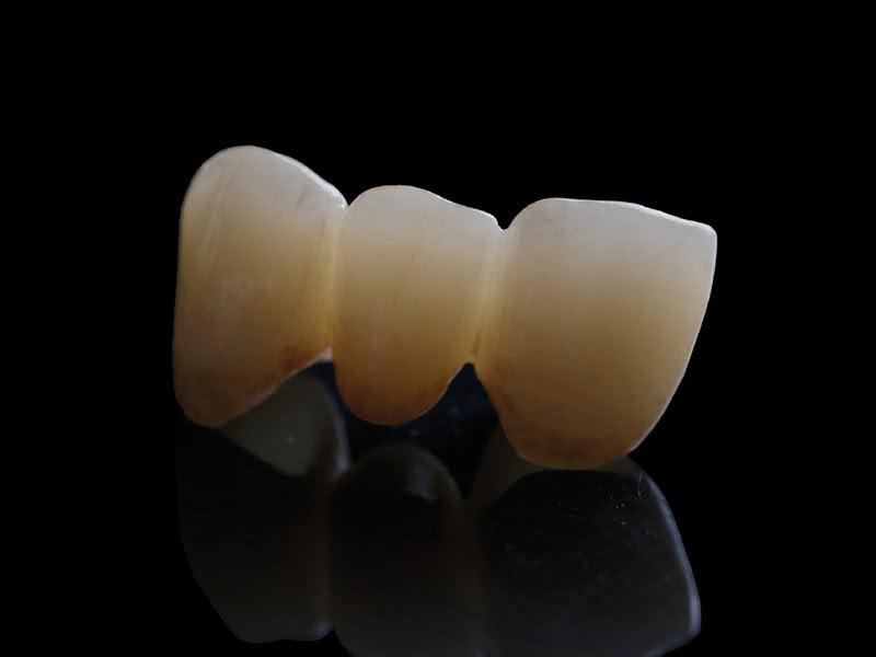 ZINTER Lumina - restauración dental multicapa de referencia