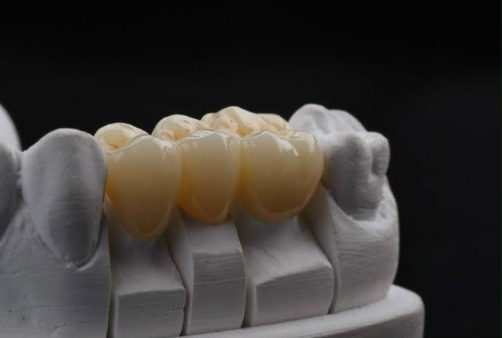ZINTER Lumina - puente dental sobre modelo de laboratorio, resultado de referencia