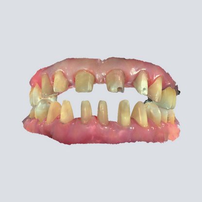 Digital Intraoral Scanner - SHINING 3D DENTAL