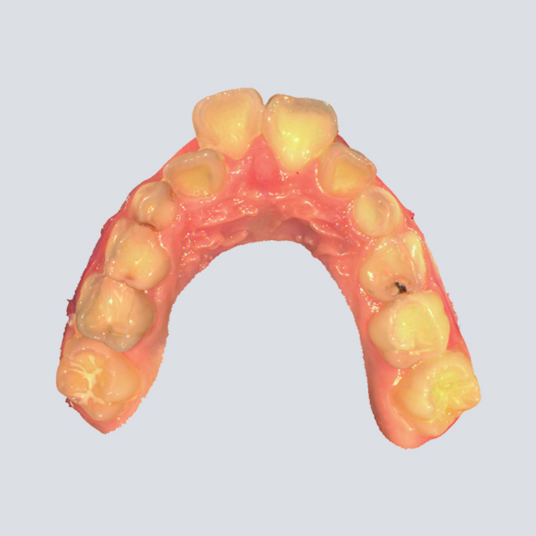 Digital Intraoral Scanner - SHINING 3D DENTAL