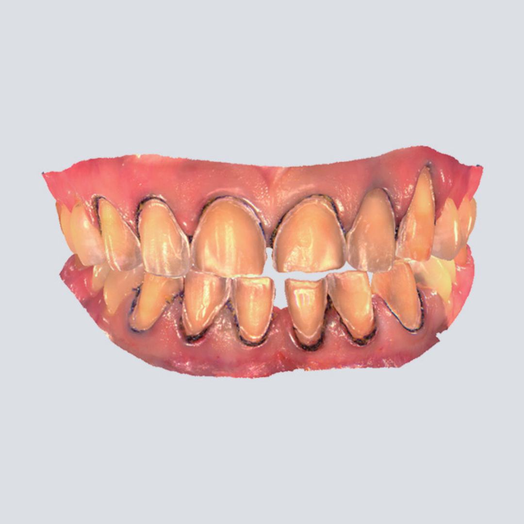 Digital Intraoral Scanner - SHINING 3D DENTAL