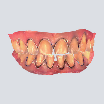 Digital Intraoral Scanner - SHINING 3D DENTAL
