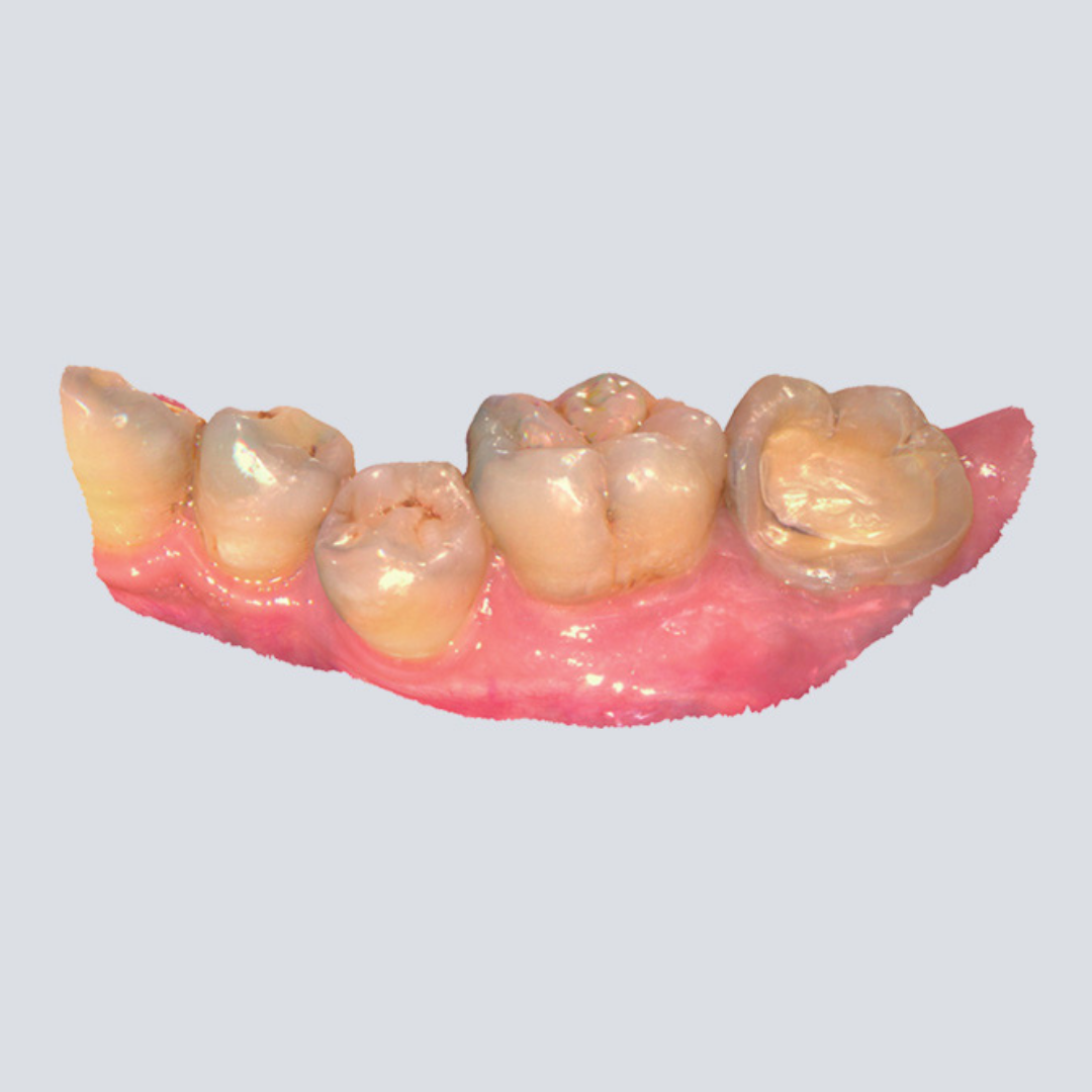 Digital Intraoral Scanner - SHINING 3D DENTAL